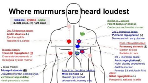 mitral stenosis murmur - Google Search