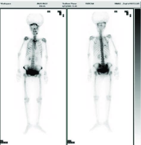 Technetium-99m MDP three-phase bones scan showing discrete uptake in 6... | Download Scientific ...