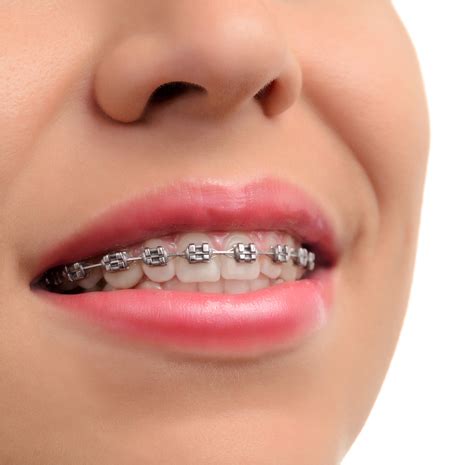 Types of Braces | Dr. Thomas Montemurno Orthodontics