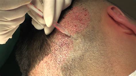 Steps of FUE hair transplant surgery.——step one,local anaesthesia - YouTube