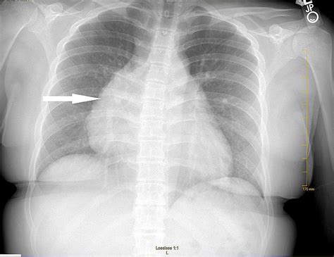 Cardiomegaly Masquerading as a Pediatric Thymoma: A Case Report | Cureus