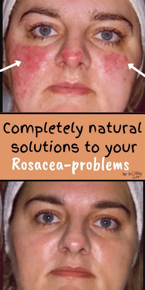 Completely natural solutions to your Rosacea-problems. | Natural remedies for rosacea, Rosacea ...