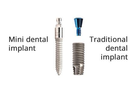 Mini Dental Implants | LuxDen Dental Implants Center | Brooklyn NY