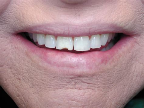 Bonding: Beautiful Result for Chipped Front Teeth! – Dr. Mark Venincasa, DDS | General ...