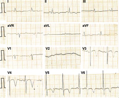 Top panel shows inverted T-waves in the leads I, II, V3, V4, V5, and V6 ...