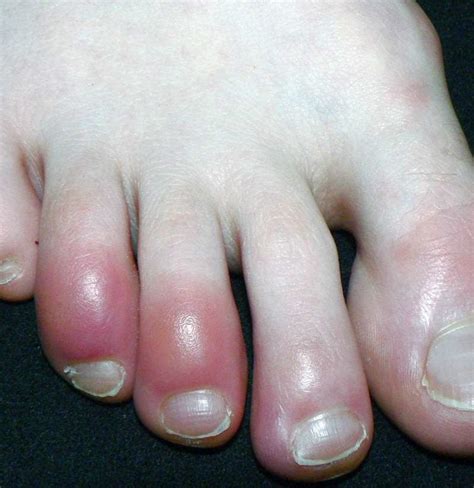 Why are my toes red? Causes, other symptoms, and treatments