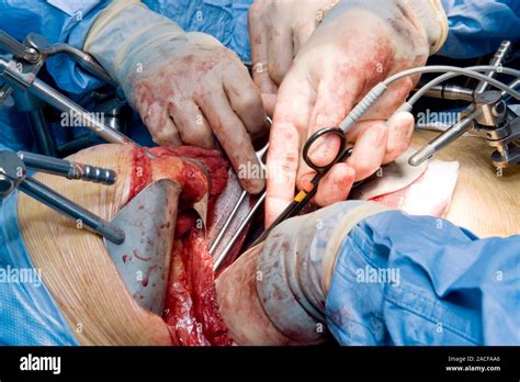 Oesophageal cancer surgery. Image 13 of 28. Surgeons operating in the chest cavity of a patient ...