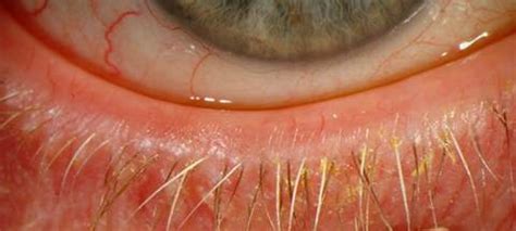 Ocular Rosacea - Pictures, Symptoms, Treatment and Causes