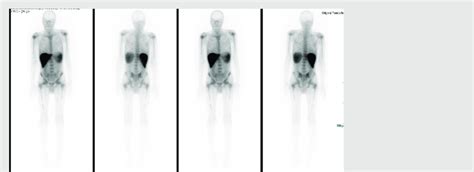 Gallium scan showing interrupted bone marrow uptake over the mid-shaft... | Download Scientific ...