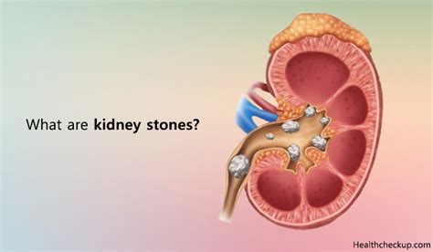 Types of Kidney Stones and Treatment | Signs & Symptoms of Kidney Stones