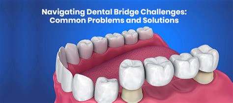 Dental Bridge Problems: Causes, Solutions, & Prevention