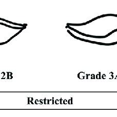 Modified Cormack-Lehane grading for laryngeal view. Grade 1-most of the... | Download Scientific ...