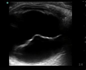 REVIEW: Ocular Ultrasound for Retinal Detachment — Staten Island University Hospital Emergency ...