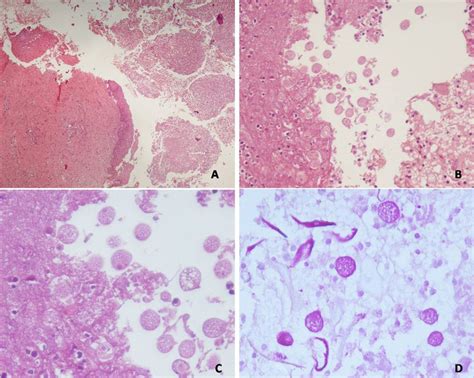 (A) Photomicrograph of a biopsy from a mass lesion showing cervical ...