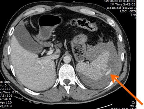 An update on nonoperative management of the spleen in adults | Trauma Surgery & Acute Care Open