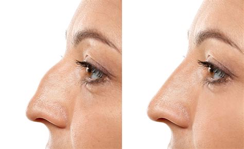 what-is-nasal-tip-rotation | rhinoplasty | blogs