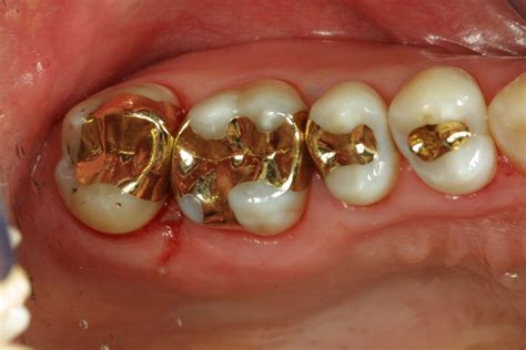 Updates in Dental Excellence: Gold Inlay Examples on My Happy Patients