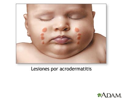 Acrodermatitis: MedlinePlus enciclopedia médica illustración