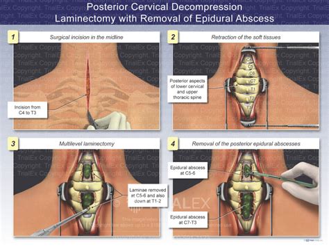 Posterior Cervical Decompression Laminectomy with Removal of an E...