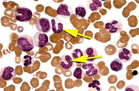 Band neutrophil or Staff Cell | Medical Laboratories