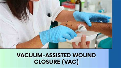 Understand the Vacuum-Assisted Wound Closure (VAC)