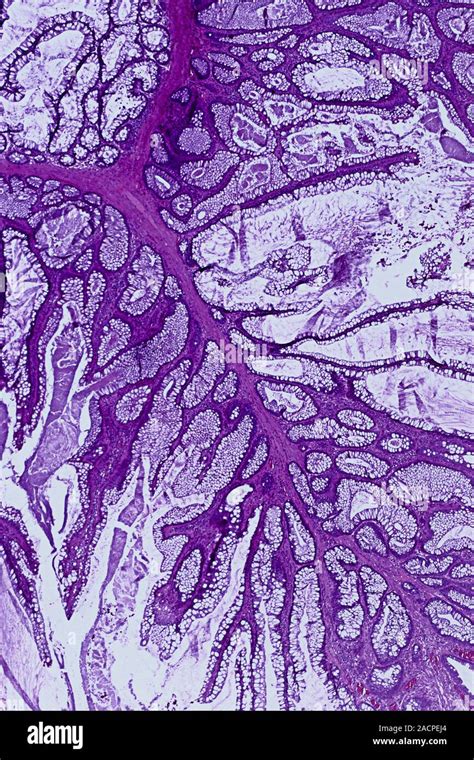 Colon polyp. Light micrograph of a section through part of a tubulovillous adenoma of the mucosa ...