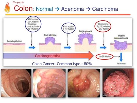 Pathology Lecture - Neoplasia