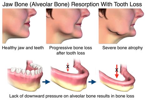 Jaw Bone Health in Ventura, CA - Oral Health & Jaw Bone Disease