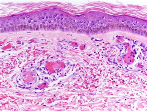 Cryoglobulinemic vasculitis: causes, symptoms, diagnosis, treatment methods | Diseases and ...