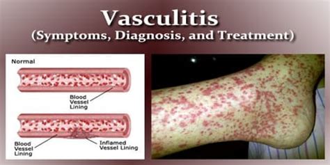 Vasculitis (Symptoms, Diagnosis, and Treatment) - Assignment Point