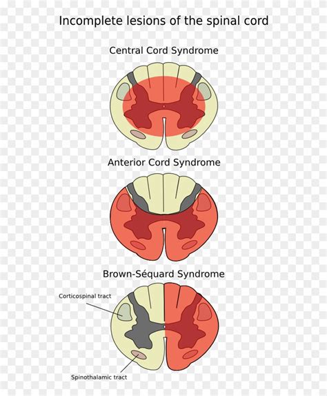 Anterior Spinal Artery Syndrome - Anterior Spinal Syndrome Clipart (#3233964) - PikPng