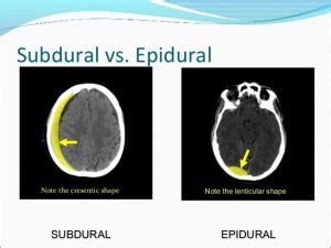 √ Diferencias entre hematoma subdural y epidural | 【SOLUCIÓN】