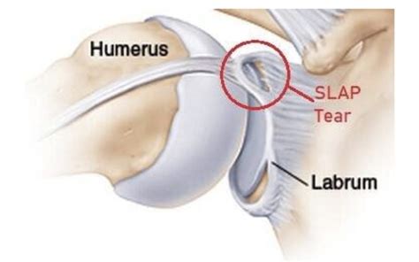 Shoulder Labral Tears - Xcell Medical Group