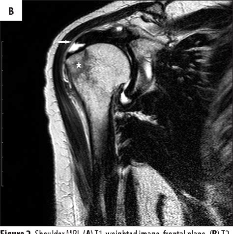 Figure 3 from Magnetic Resonance Imaging of Rotator Cuff Tears in Shoulder Impingement Syndrome ...