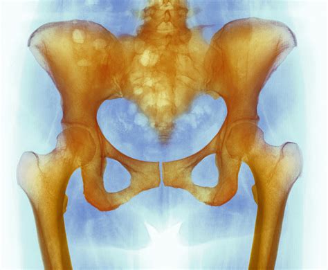 Healthy Hip Bones, X-ray Photograph by - Pixels