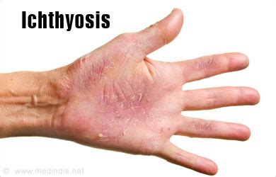 Ichthyosis - Causes, Symptoms, Diagnosis, Treatment, Complication, Risks