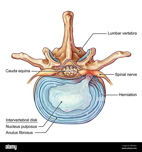 Lumbar disk herniation hi-res stock photography and images - Alamy