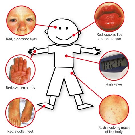 Kawasaki Disease symptoms: fever lasting 5 days, red eyes, body rash, swollen cracked lips ...