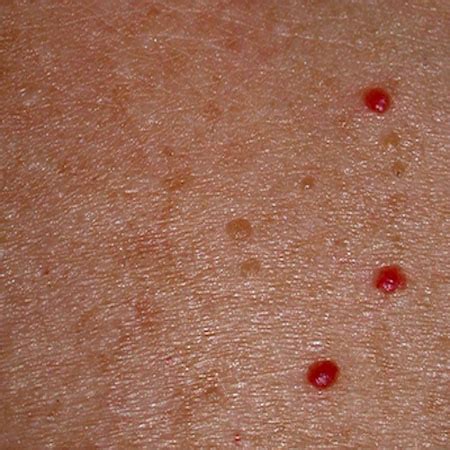 Bright Red Small Spots on Skin images