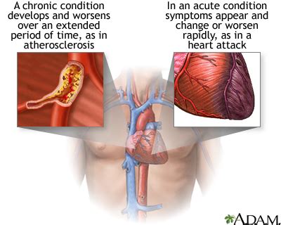 Acute vs. chronic conditions: MedlinePlus Medical Encyclopedia Image