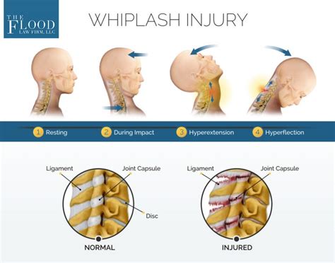 Whiplash Injury FromA Car Accident | Connecticut Injury Attorney