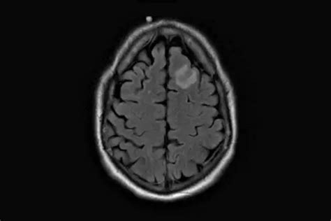 Tumefactive Multiple Sclerosis: What Is It, Symptoms and Treatment