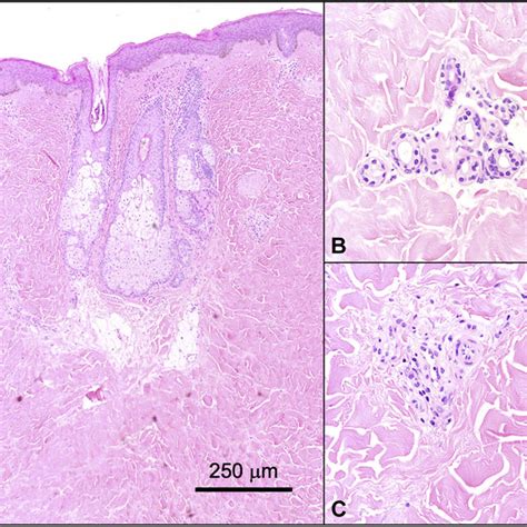 Localized scleroderma (morphea). Expansion of the dermis by thickened,... | Download Scientific ...