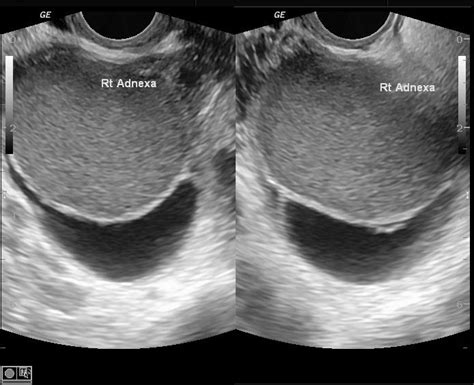 endometrioma ultrasound - Google Search | Endometriosis | Pinterest | Endometriosis and Ultrasound