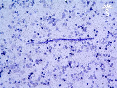 Pathology Outlines - Dirofilaria repens