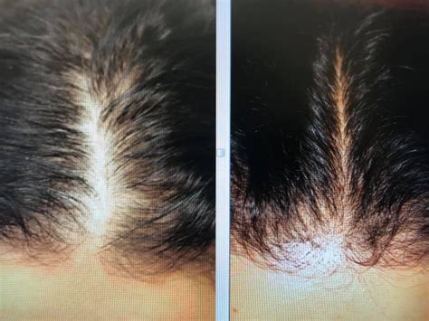 Hair Restoration for Women and Men | Rejeune MD Wellness and Aesthetics