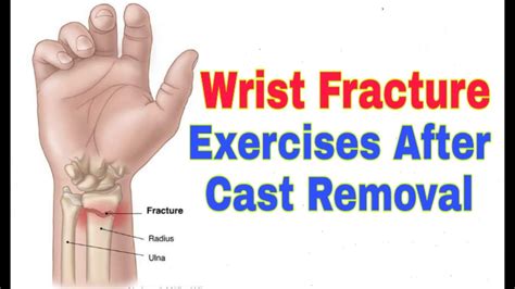 Wrist Exercises After Fracture in Hindi | Wrist Fracture after Cast Removal - YouTube