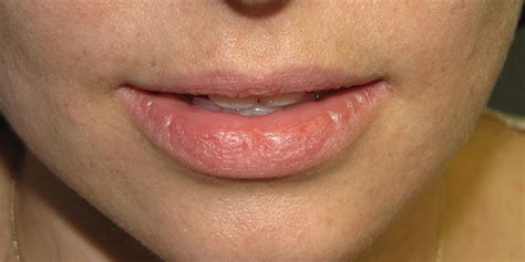 What Does Melanoma Look Like On Lips | Lipstutorial.org