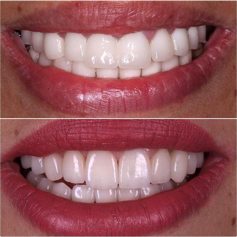 Thick and dull zirconia crowns were replaced with more natural looking IPS e.max restoratio ...