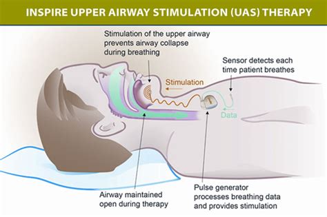 New treatment for sleep apnea? | Respiratory Medicine Consultants